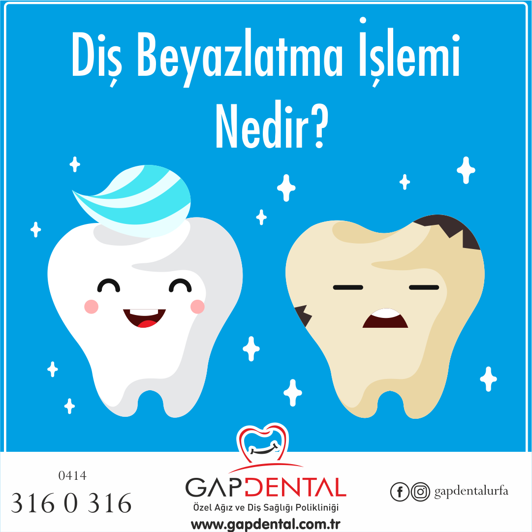 Di Beyazlatma lemi Nedir?