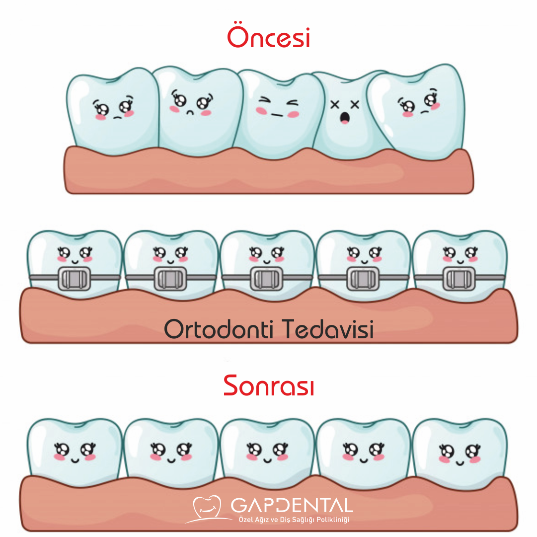 Ortodonti (Di Teli Tedavisi )
